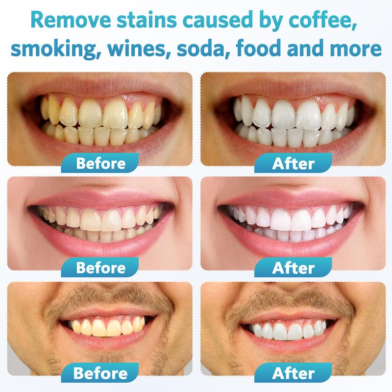 BESTEK Teeth Whitening Kit - 32X LED Light Tooth Whitener with 35%C Teeth Whitening Gel,  Remove Stains from Coffee, Smoking