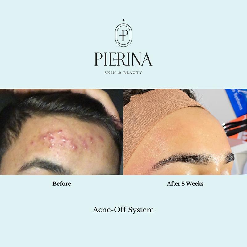 Acne Off System