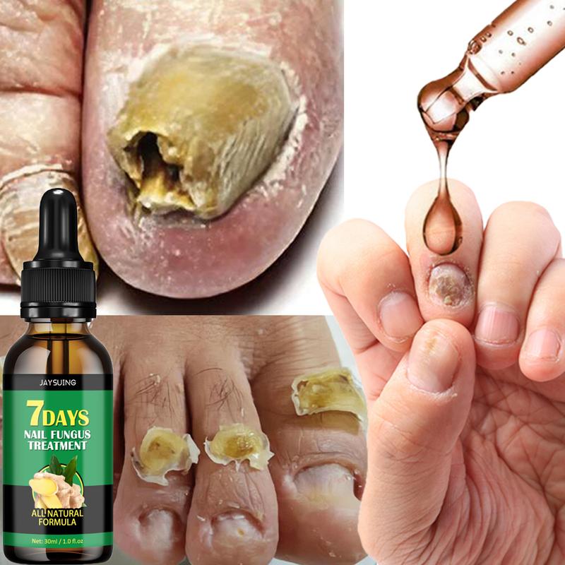 Nail Fungal Treatment Essential Oil Nail Fungus Removal Serum Foot Toe Onychomycosis Repair