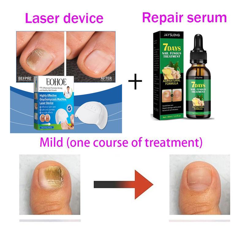 Nail Fungal Treatment Essential Oil Nail Fungus Removal Serum Foot Toe Onychomycosis Repair