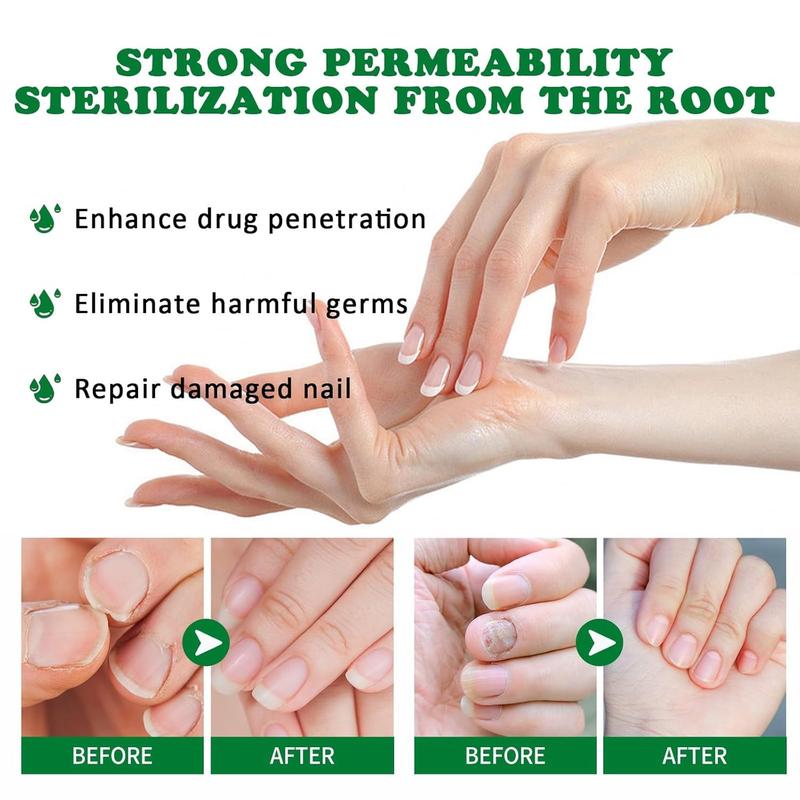 7days Nail Fungus Treatment, Ginger Nail Treatment, Multi-Purpose Nail Repair, Nail Nutrient Oil Strengthener Oil Serum Ginger Nail Growth Oil