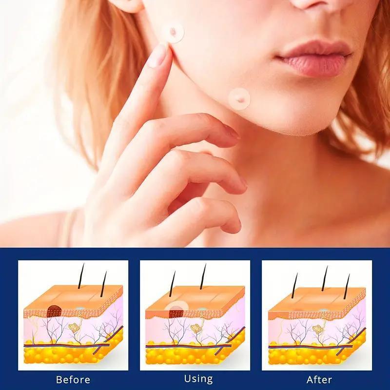 1 Box(144 Patches) Skin Tag Cover Patches, Mole & Wart Remover, Acne Pimple Patch for Covering Zits and Blemishes