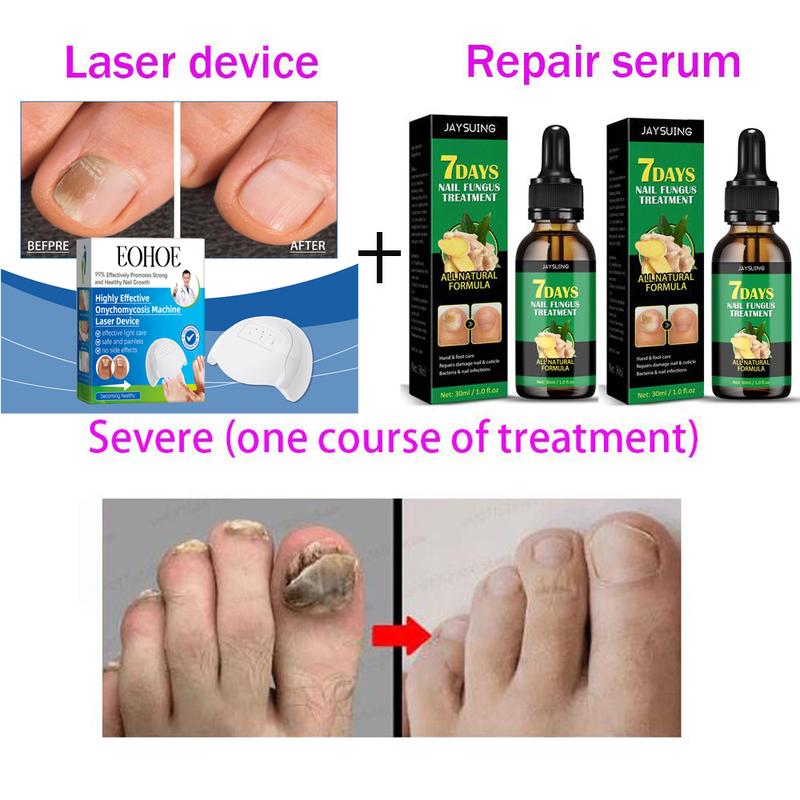 Nail Fungal Treatment Essential Oil Nail Fungus Removal Serum Foot Toe Onychomycosis Repair