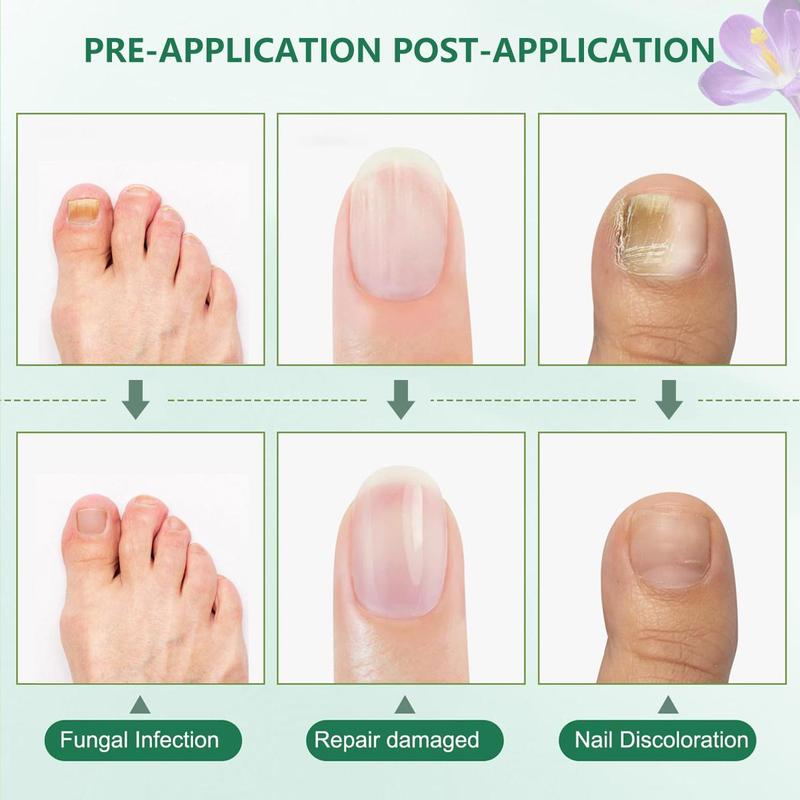 Toenail Fungus Treatment Extra Strength for Athletes Foot, Thick, Broken, Discolored Nail Nail Care Case Sensitive Nail Polish