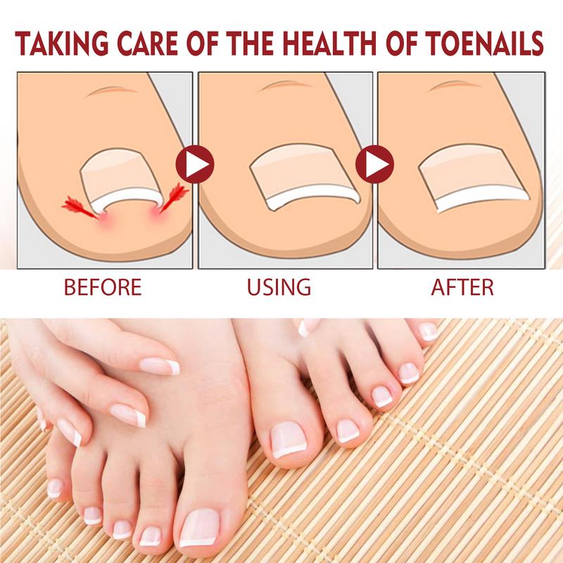 Natural Anti Paronychia Relief Oil, Ingrown Toenail Removal, Correction Treatment Oil for Damaged & Discoloration Nail