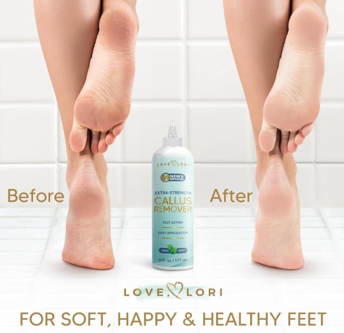 Callus Remover for Feet (Extra Strength) Foot Scrubber for Dead Skin Callus Gel - Professional Pedicure Foot Spa Essential, 6oz