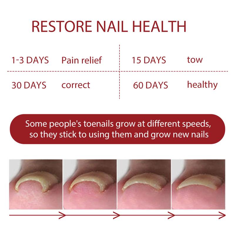 Natural Anti Paronychia Relief Oil, Ingrown Toenail Removal, Correction Treatment Oil for Damaged & Discoloration Nail