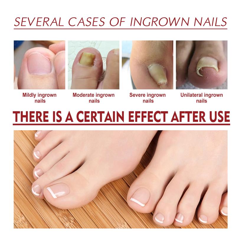 Natural Anti Paronychia Relief Oil, Ingrown Toenail Removal, Correction Treatment Oil for Damaged & Discoloration Nail