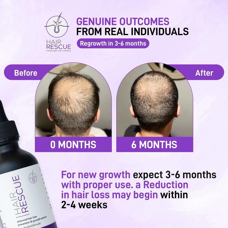 Hair Rescue - Advanced Hair Loss Prevention and Growth Serum - Haircare Minoxidil Derma Comfort Repair