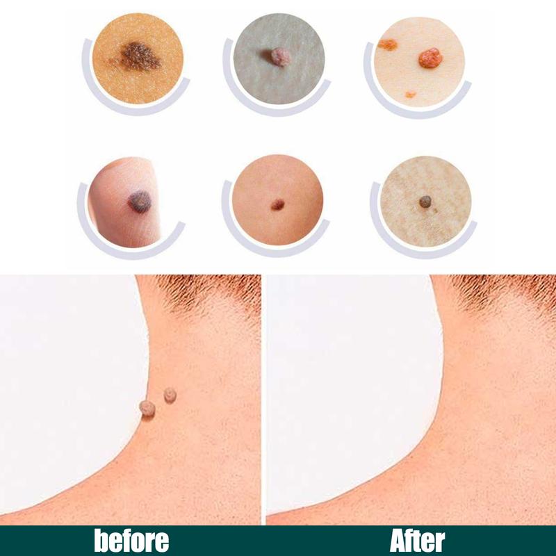 Jaysuing Verruca Patch Repair Smooth Skin Fade Facial moles Acne Skin Tag Verruca Patch