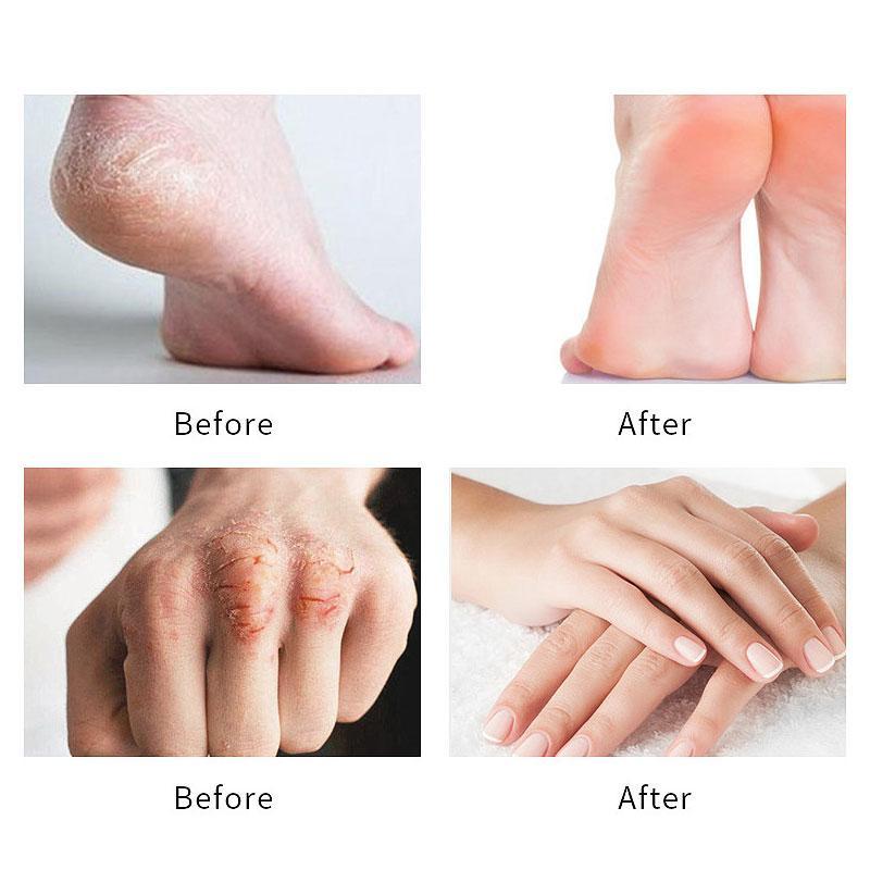 Urea Cream for Handand Feet, Cream Smoothing Cracked Hands and Feet, Moisturizing Urea Cream for Dry and Cracked Skin