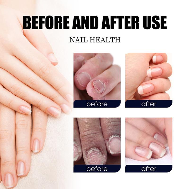 [90% People Choose] Toenail Drops Nail Drops for Toenail Odor and Fungal Infections and Nail Drops