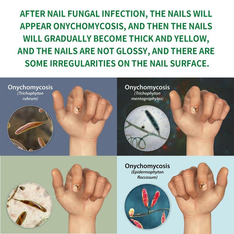 Ginger Nail Treatment Nail Support Nail Care