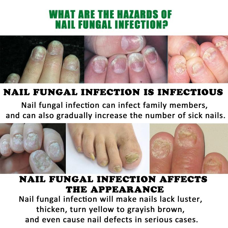 Ginger Nail Treatment Nail Support Nail Care