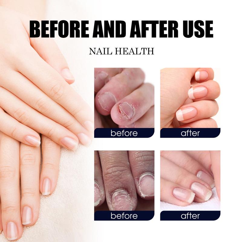 Anikila hongo, Tea Tree, Oregano oil nail supportNail Care Lavender Manicure Nail Polish Therapy