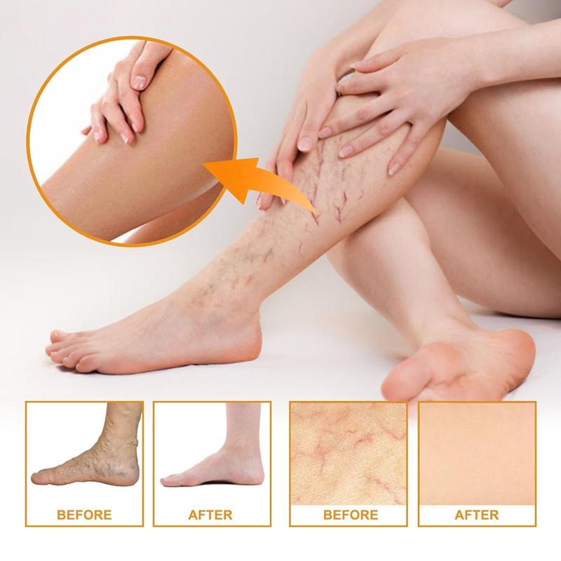 2 Bottle Varicose Veins Miracle Cream, Vitamin K Cream, K Miracle Cream, Vitamin K Cream Suitable for Legs and Face, Suitable for All Skin Types, Deeply Nourishing and Moisturizing